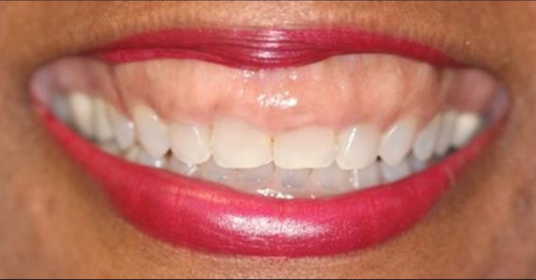 Gummy Smile Corection Izcand Tadsandcrown Lengthening Procedure