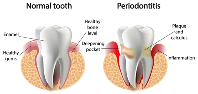 What is Gum Disease?