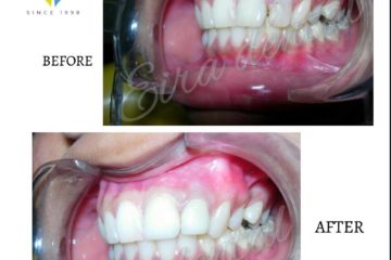 Veneers for perfect smile.21yr old.Female.patient