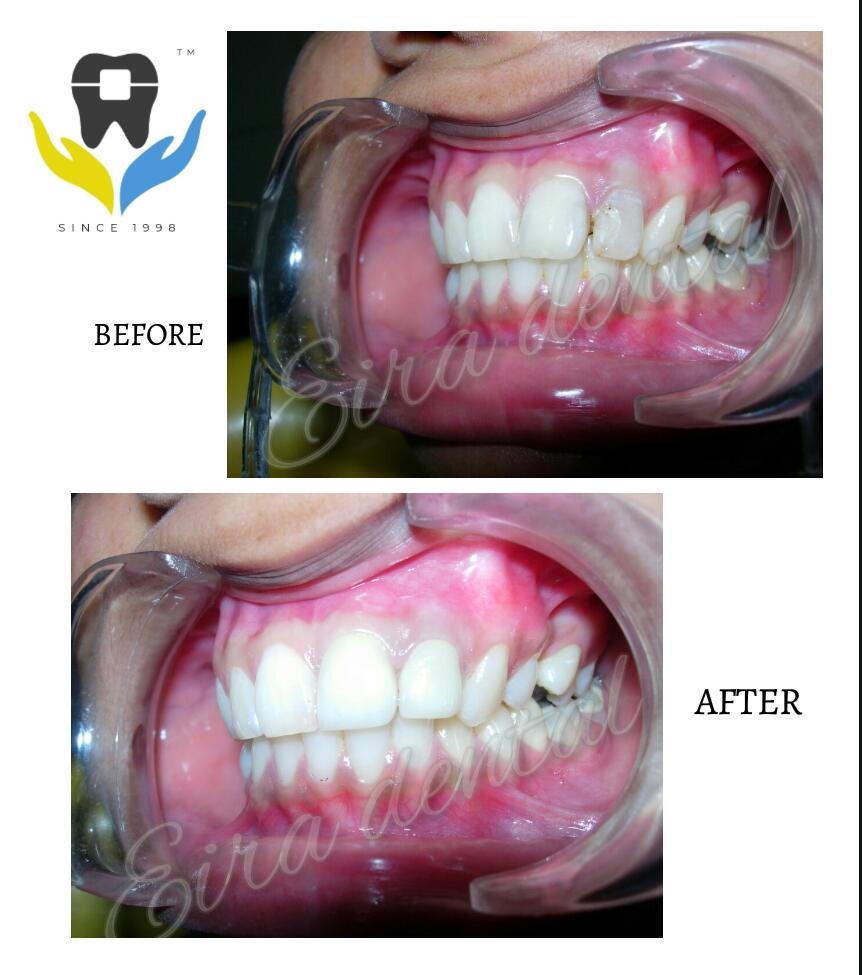 Veneers for perfect smile.21yr old.Female.patient