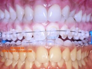 Ceramic Braces