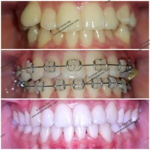 Ceramic Braces